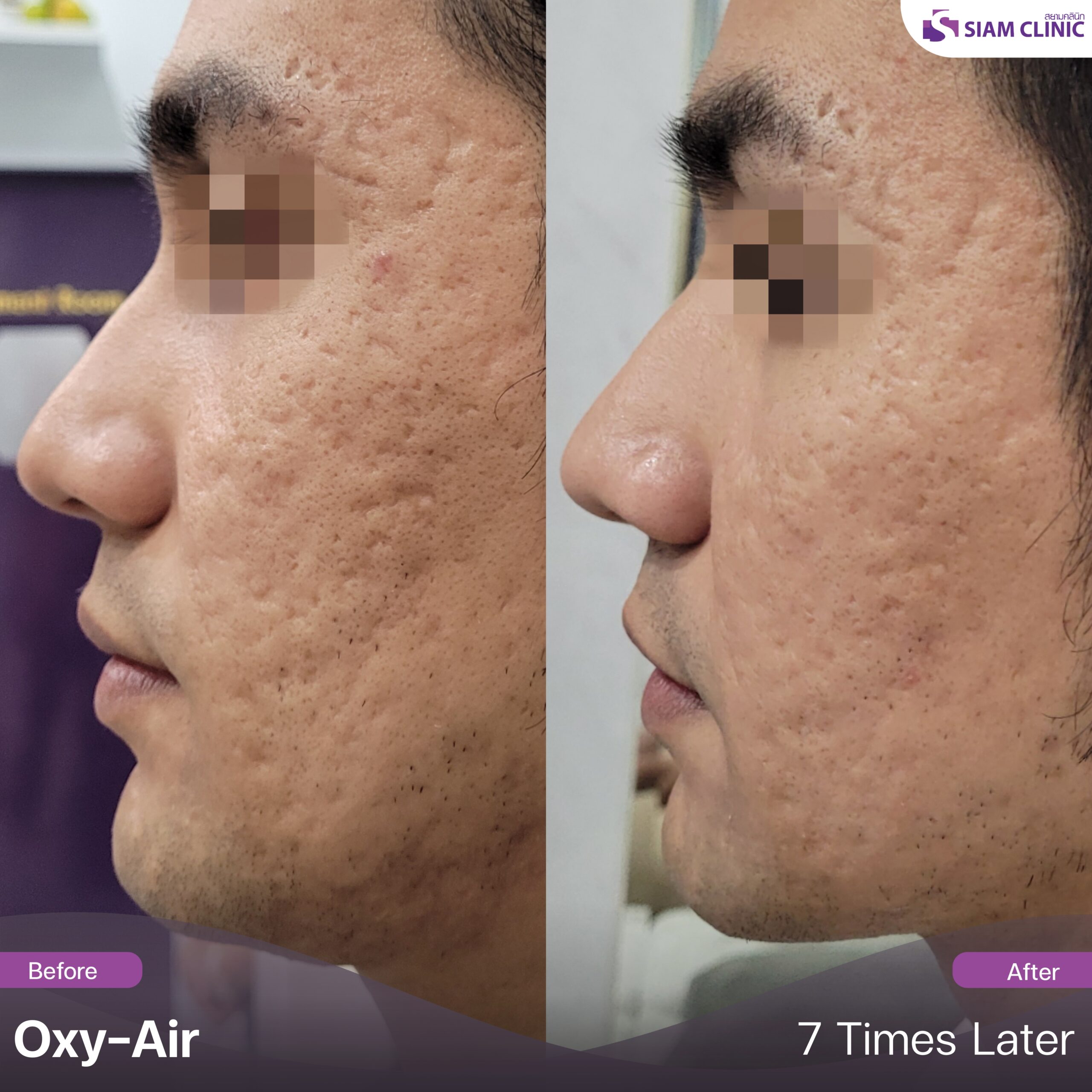 Acne Scar Treatment Before And After Photos Siam Clinic Thailand Acne Scar Treatment Before And After Photos Siam Clinic Thailand