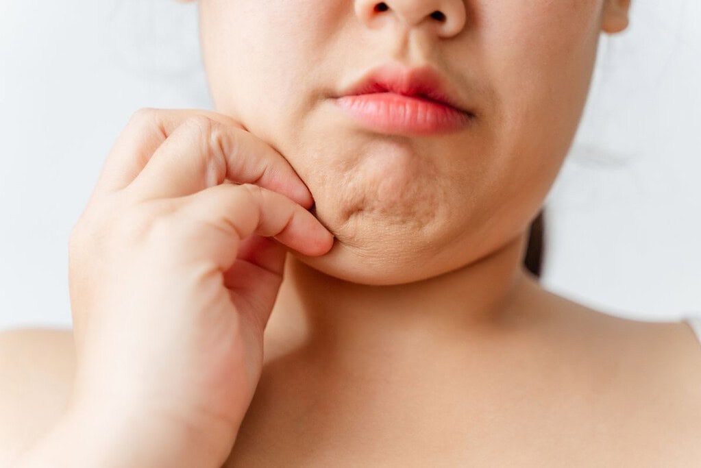 แก้มป่อง