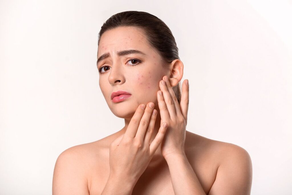 วิตามินลดสิว