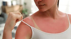 Learn about the long-term consequences of untreated sunburn, including premature aging, hyperpigmentation, and increased skin cancer risk. Discover why it’s important to treat your sunburn and protect your skin for the future.