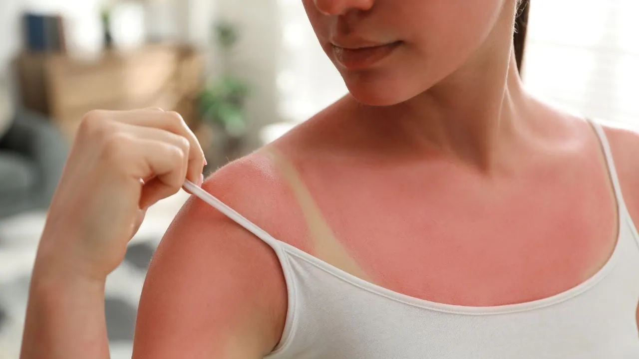 Learn about the long-term consequences of untreated sunburn, including premature aging, hyperpigmentation, and increased skin cancer risk. Discover why it’s important to treat your sunburn and protect your skin for the future.