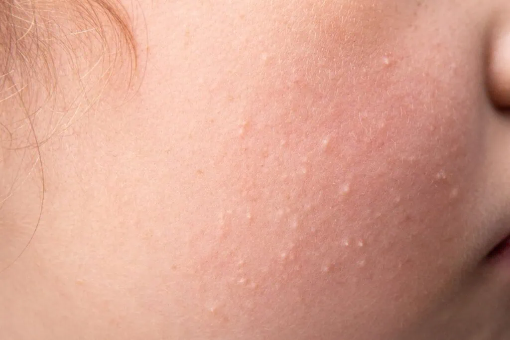 สิวข้าวสาร