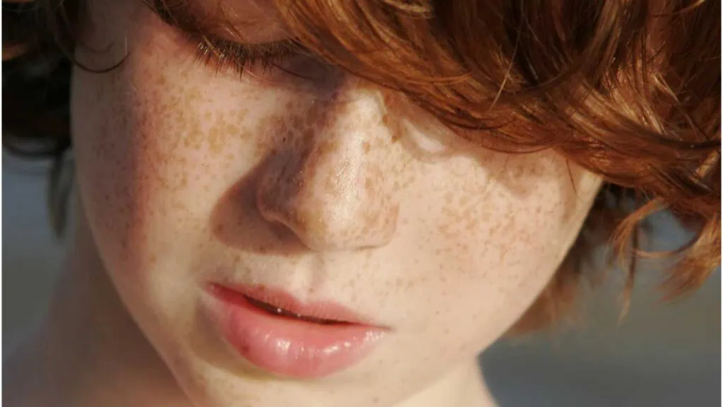 Freckles in East Asians come from sun exposure. In Europeans, it’s genetic. Learn how the MC1R gene plays a role in your skin’s response to UV.