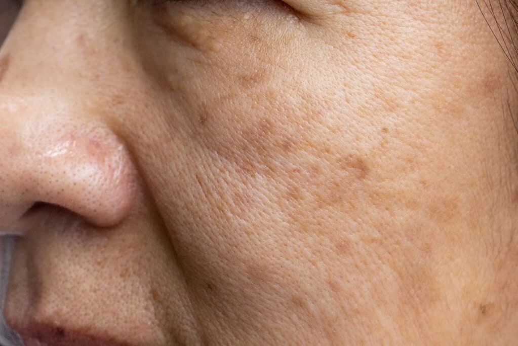 Melasma