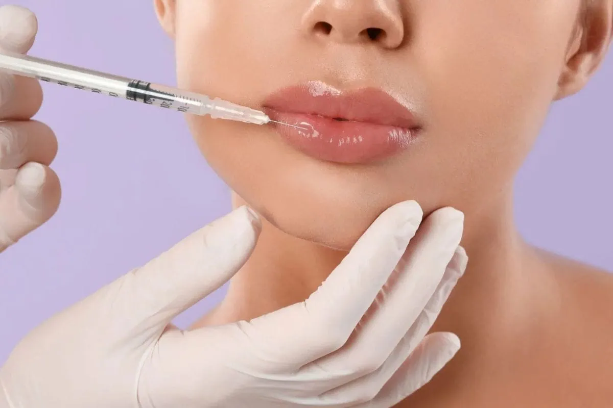Cosmetic lip injection procedure using a syringe.