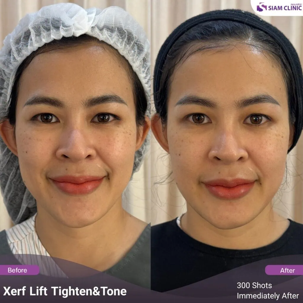 Before and after immediate facial skin tightening results.