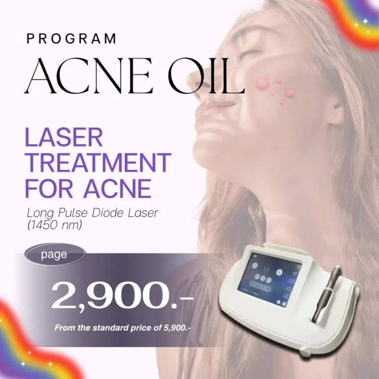 Acne oil treatment program advertisement featuring a woman with acne and a laser device, promoting laser treatment for acne at 2,900 THB, with a long pulse diode laser (1450 nm).