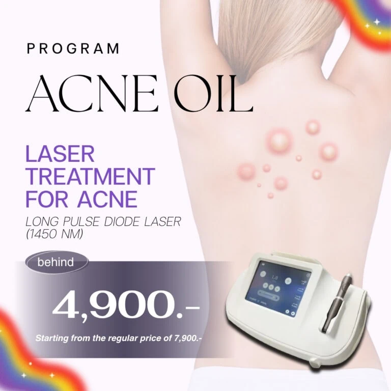ACNE OIL laser treatment advertisement featuring a woman’s back with acne, a laser device, and promotional text in purple and black on a white background.
